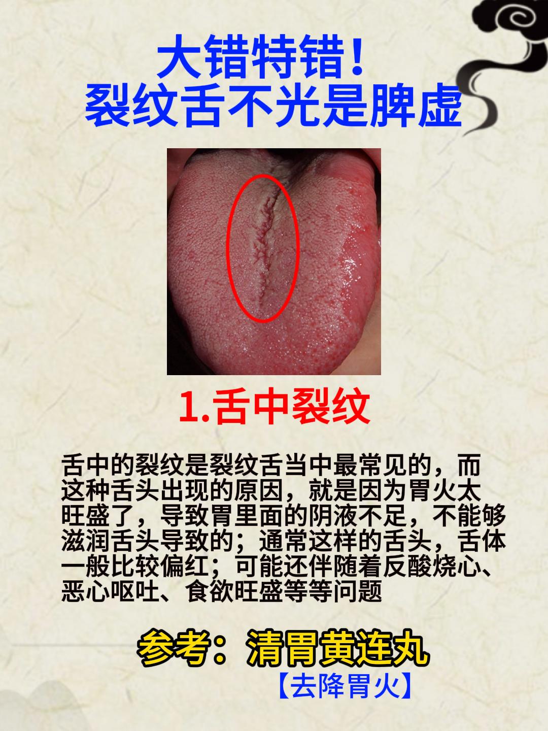 大错特错！裂纹舌不光是脾虚，对照看看，你是属于哪一种？[谢谢][谢谢][谢谢]