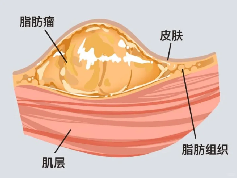 皮下鼓个包，有时还有点疼