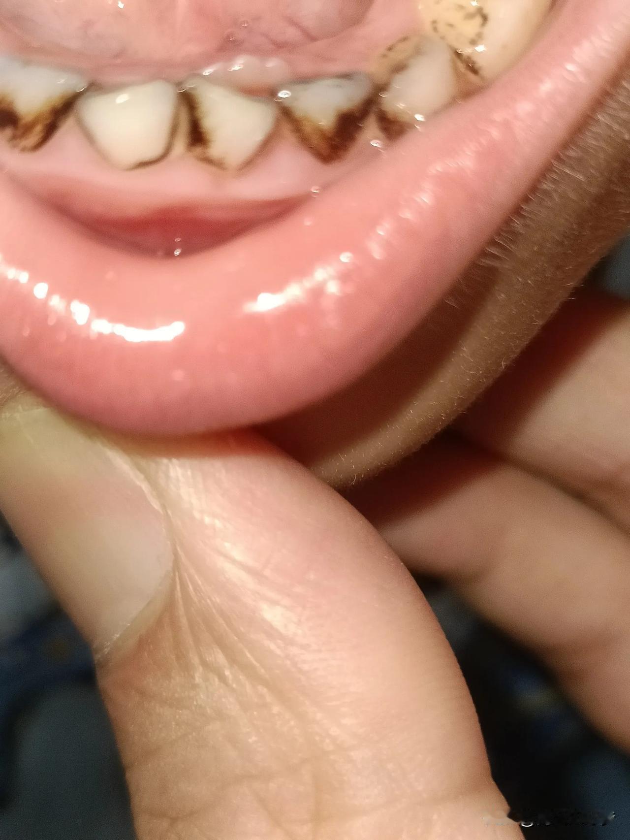 注意上面牙齿，下面牙已经长出来了，但不怎么摇怎么办？[我想静静]
牙齿 牙齿健康