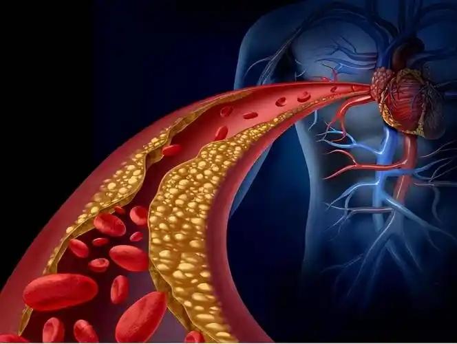 一个60多岁的老伙计，血脂飙到9.2，偏偏还说：“我就喝一点，不碍事。”结果一个