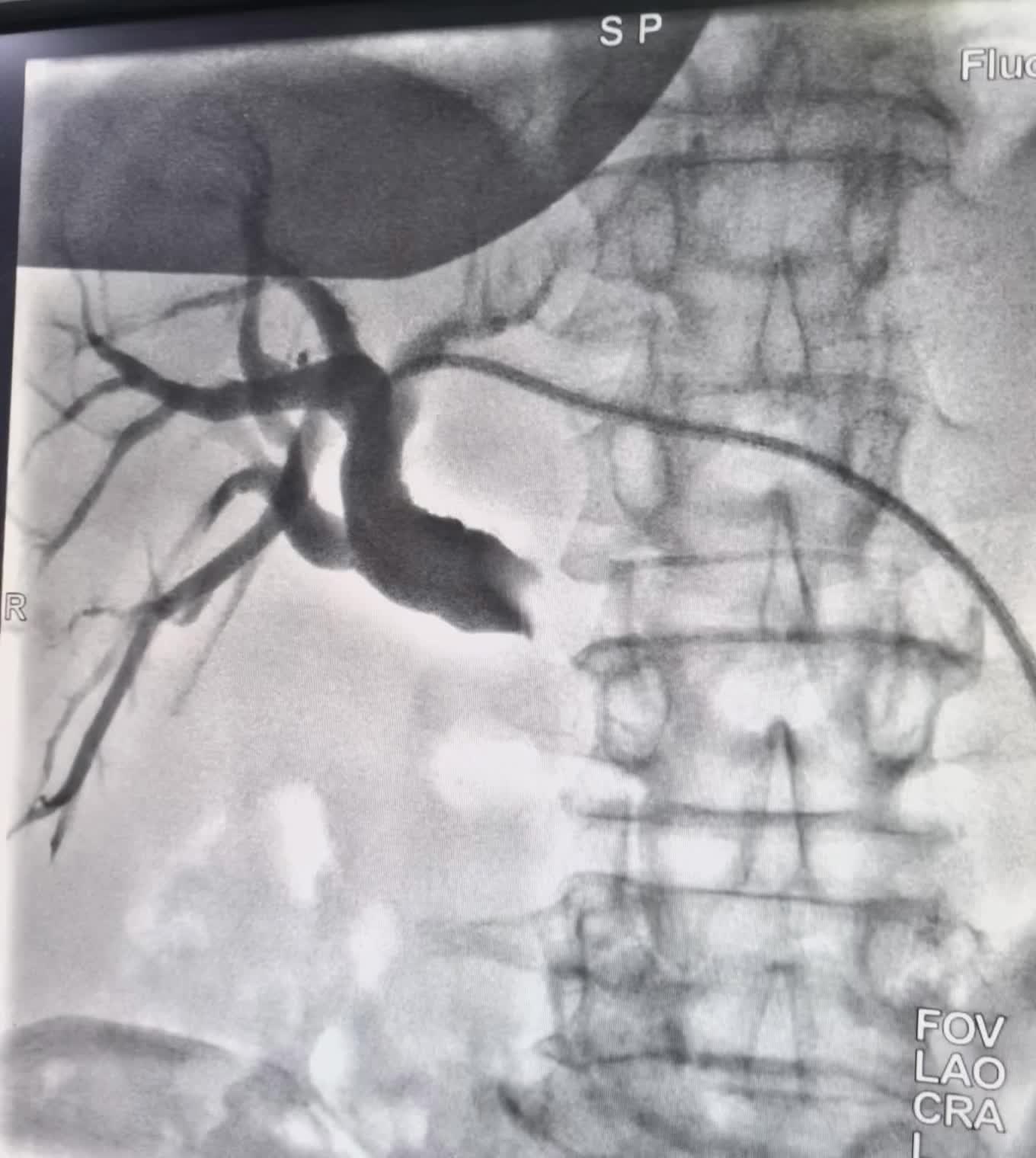 一例胰头癌压迫胆管引起的梗阻性黄胆伴胆管 一例胰头癌压迫胆管引起的梗阻...