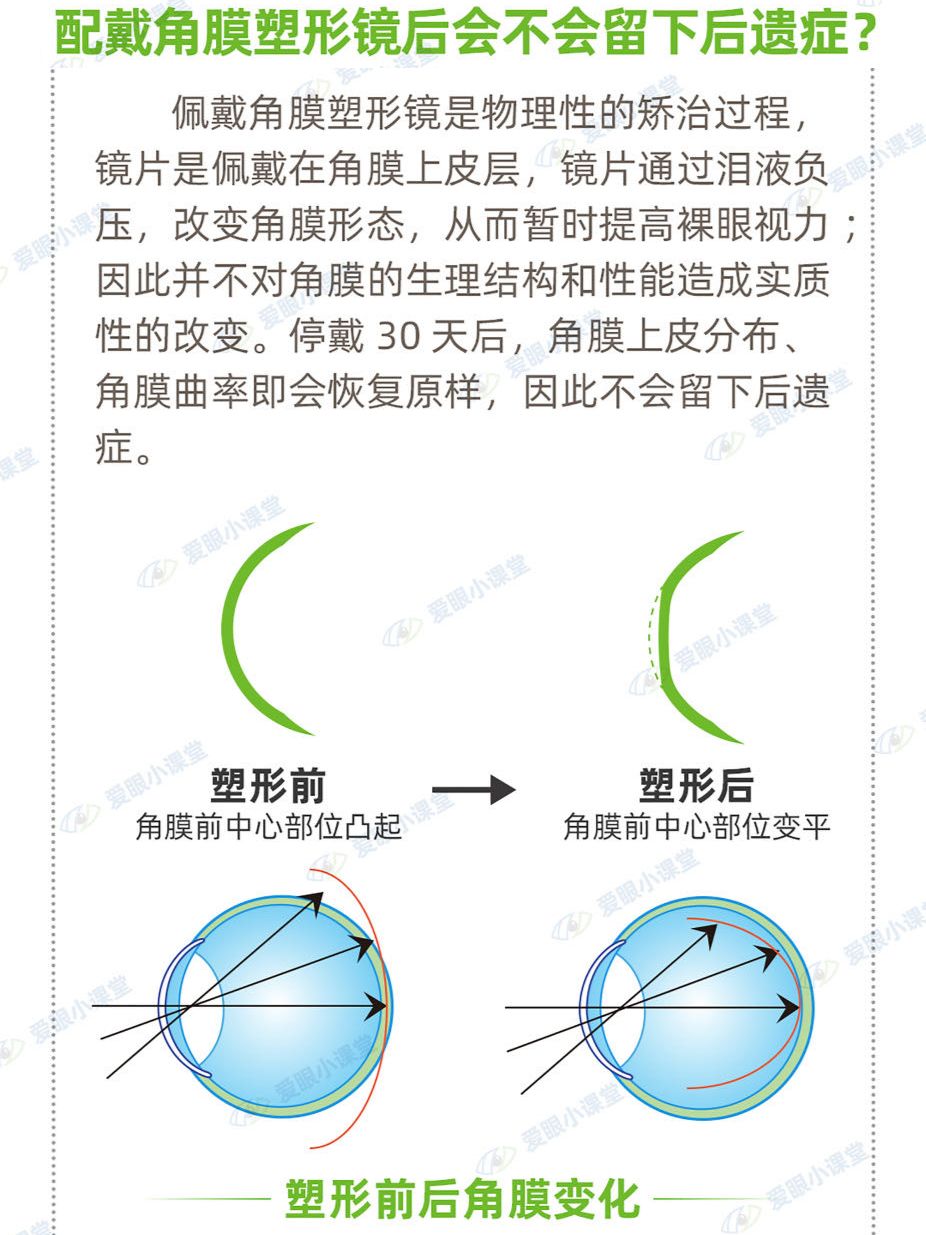配戴角膜塑形镜后会不会留下后遗症？