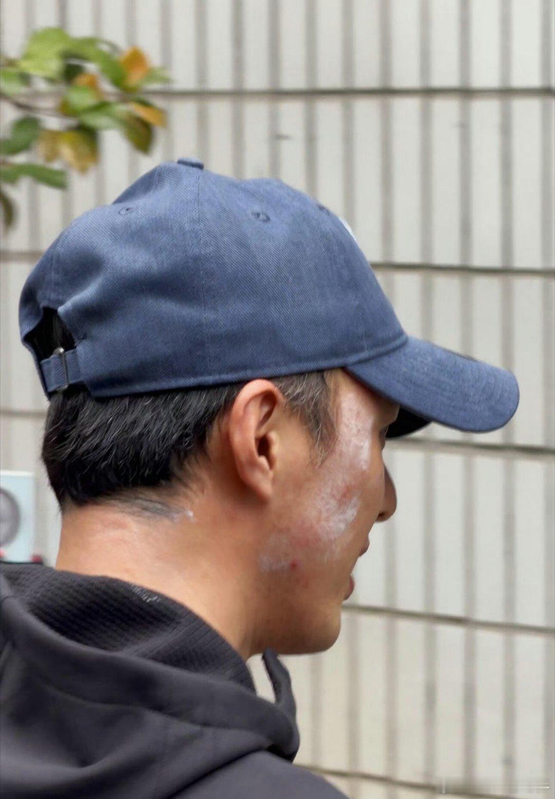 剧组头套胶水粘得太紧，叶祖新脸侧边撕头套受伤了叶祖新的脸怎么了没想到头套居然这么