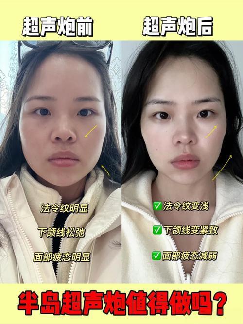 朱丹近日自曝五年前尝试热玛吉医美项目时，刚操作几分钟就被强烈的灼烧感击溃，当场恳