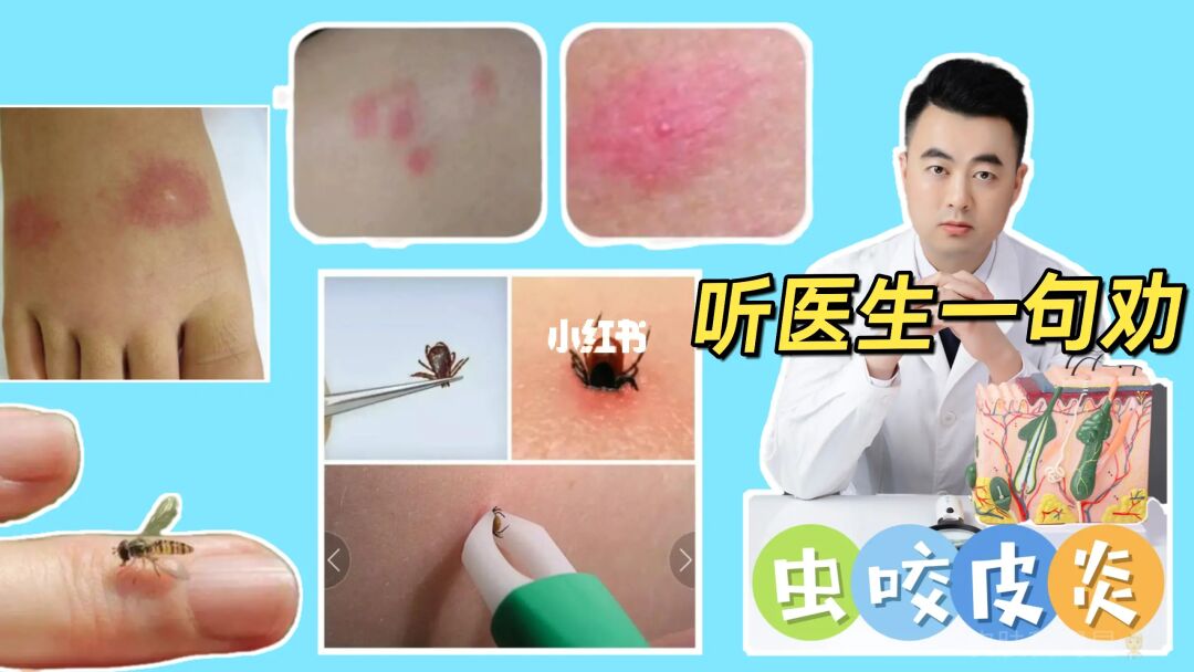 蚊虫叮咬后怎么办？