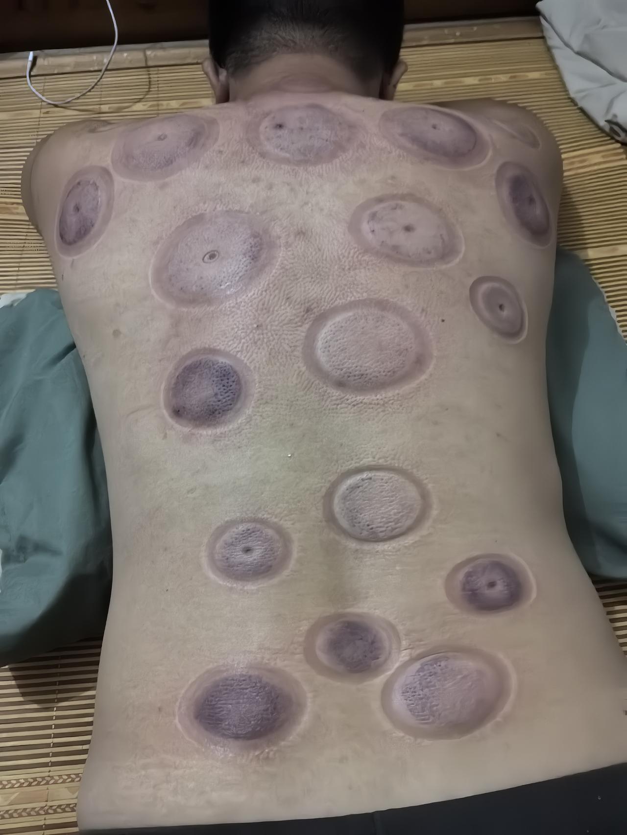 夏日生活打卡季拔罐广西桂林
