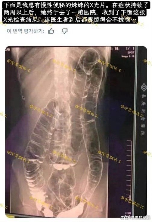 便秘两周的人的X光检查结果长时间肠道代谢受阻，拍片画面尽显体内堆积的厚重状态况便