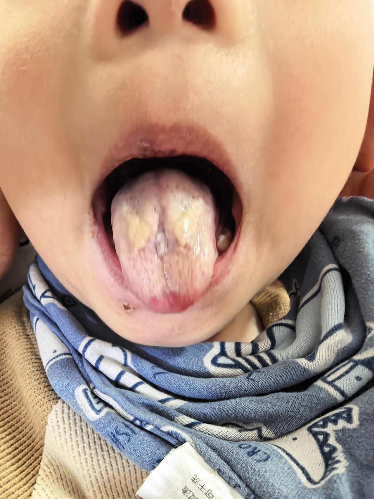 你敢相信这是同一个孩子的舌苔吗？第1个是三天前孩子不吃饭来诊，第2个是用中药贴敷