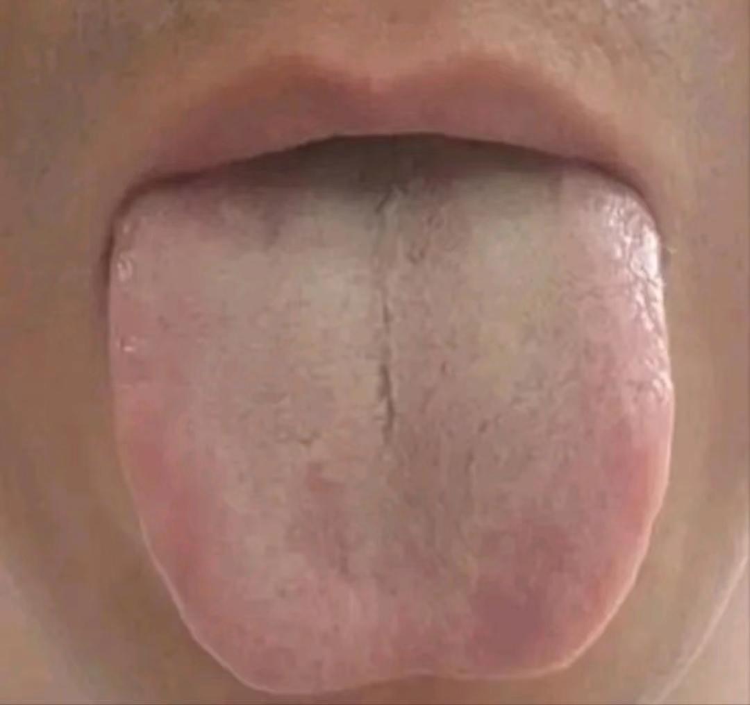 舌头中间有裂纹，如果你按脾肾阳虚来治，那再怎么治都没用！
患者主诉夫妻生活中总是