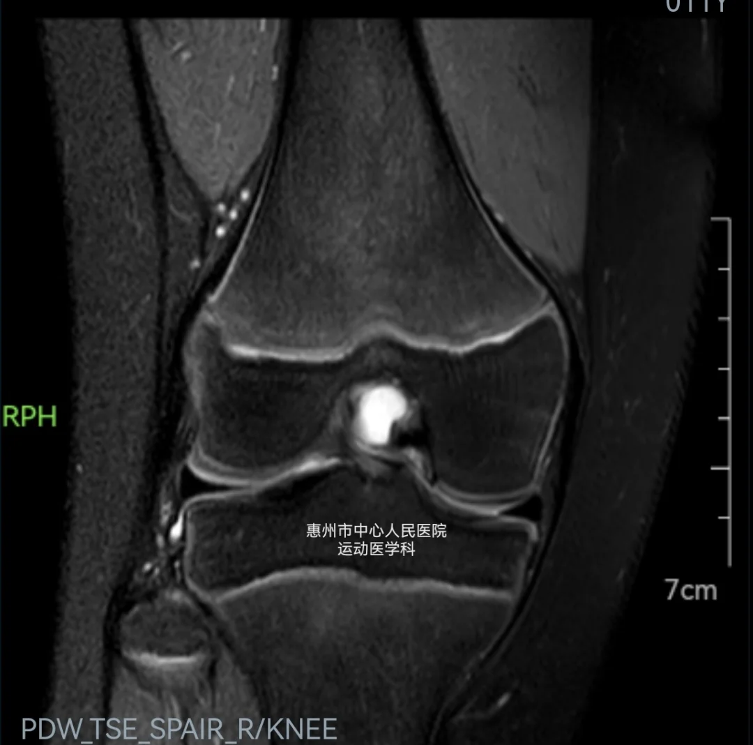 小朋友膝盖痛，怎么办？