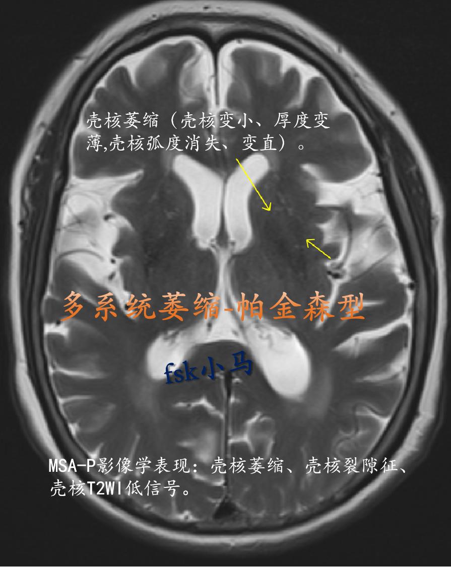 多系统萎缩(MSA)是一种成年起病的严重的神经系统退行性疾病，临床表现...