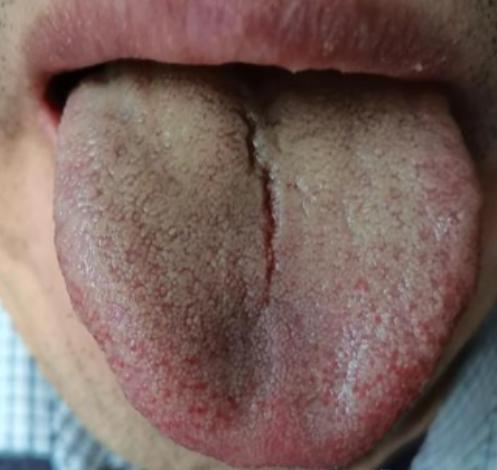说实话，这样的舌象，但凡再晚来几天，我都不会接诊，肾虚成这样，真不知道每天晚上再