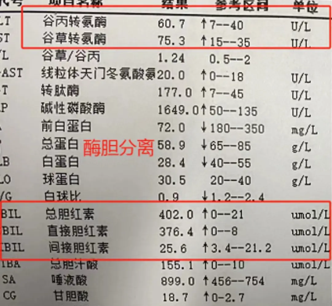 酶胆分离通常是指在重症肝炎等严重肝脏疾病时出现的一种生化指标异常表现。...