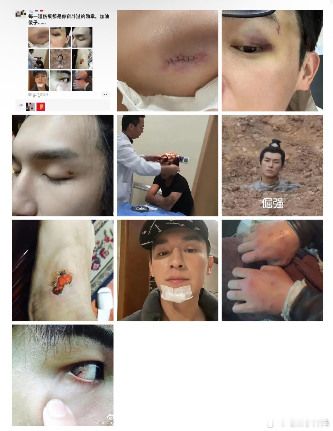 杨旭文经纪人半夜发的《唐诡》收官朋友圈，卢凌风的天花板打戏都是这些伤口换来的，都