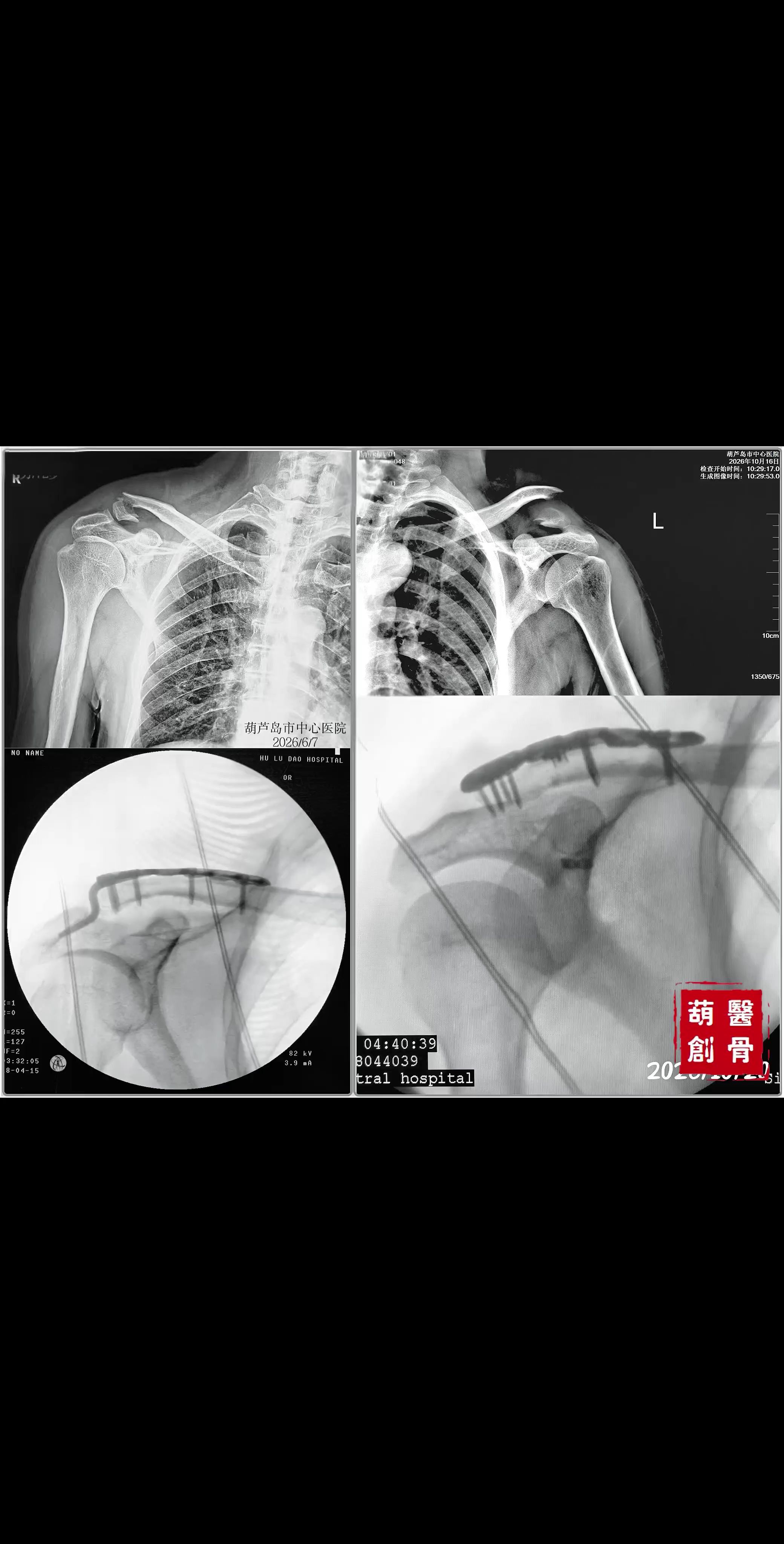 锁骨远端骨折的两种手术方法，孰优孰劣？ ❶锁骨钩钢板，操作简单，但术后...