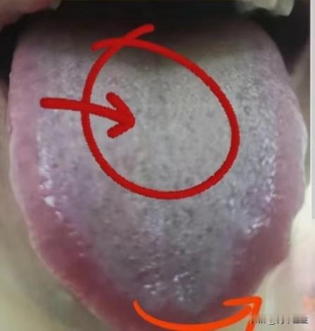 这种黄腻苔，不要上来就清热，补阳，否则只会加重！

这是前几天来看诊的一名男性患