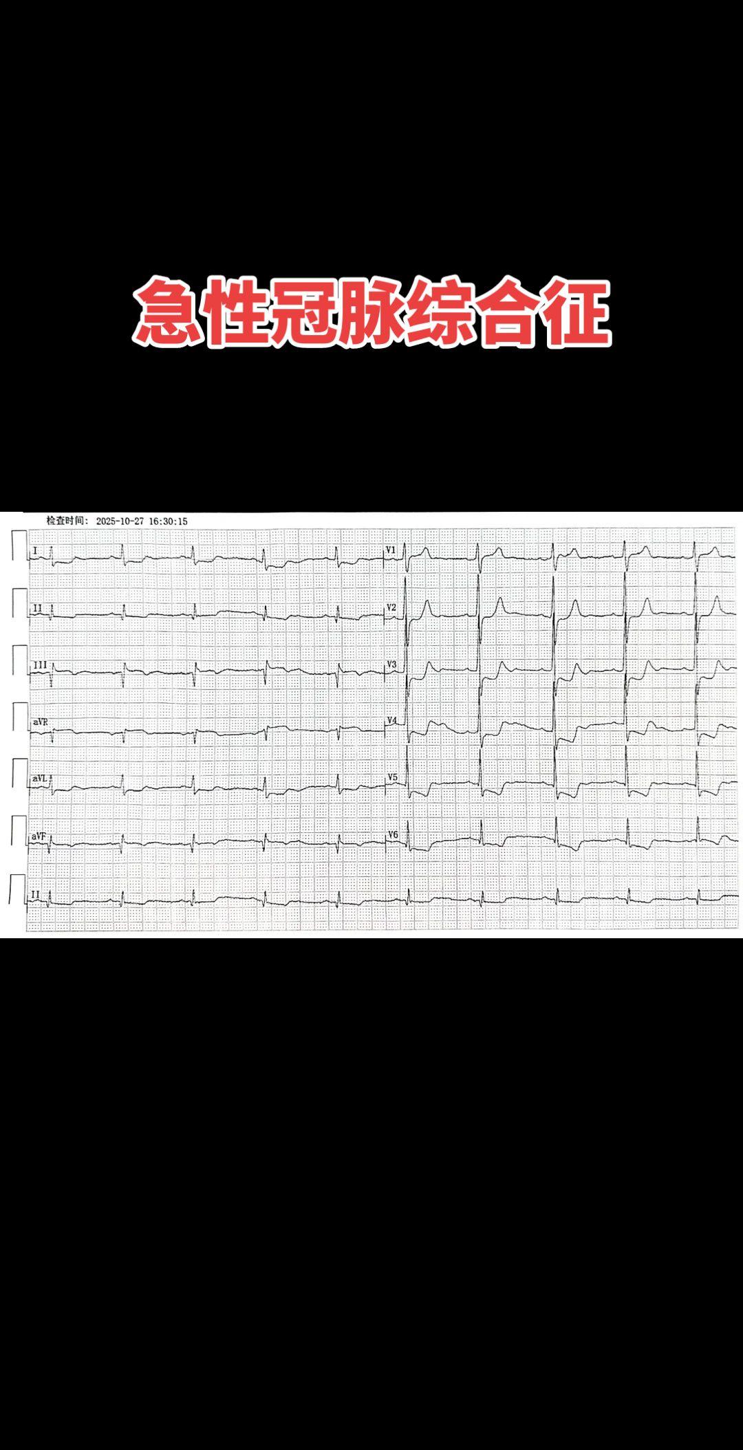 Aslanger综合征的核心诊断标准：  III导联孤立性ST段抬高。...