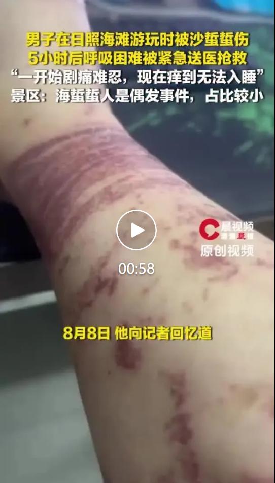 暑期不少游客会到山东日照万平口沙滩踏浪消暑，来自徐州的陈先生在此游玩时意外被沙蜇