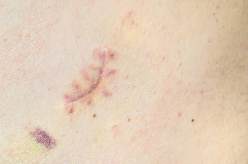 女子称入住西安一酒店时淋浴间玻璃门突然爆裂，造成右臂十余处伤口，酒店不愿承担疤痕