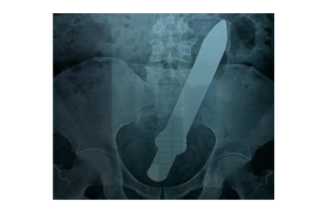 【#深圳14岁男孩网购假阳具塞入肛门#！“不小心整个滑进去”，医生提醒】#14岁