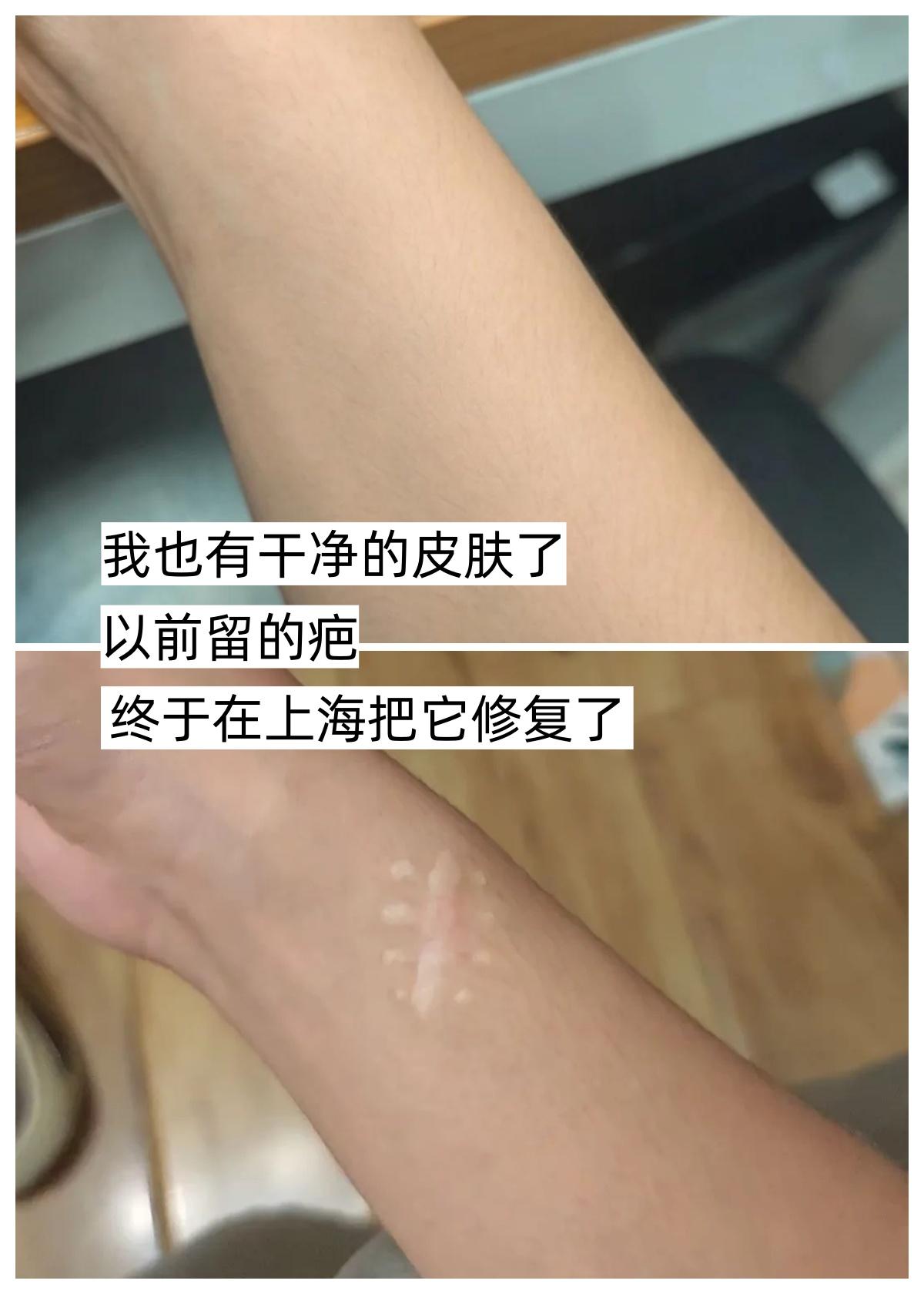 谁不想拥有干干净净的皮肤啊，之前做手书留下的疤痕后期增生凸起，看着特别...