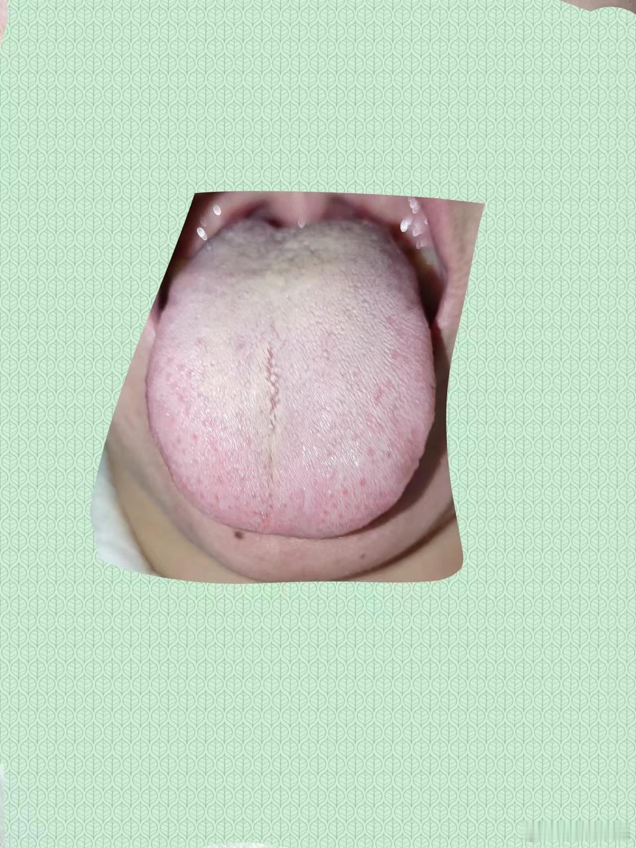 #乙肝[超话]#粉丝问这舌苔与乙肝的关系，可能没有关系，甚至，舌苔从现代医学角度