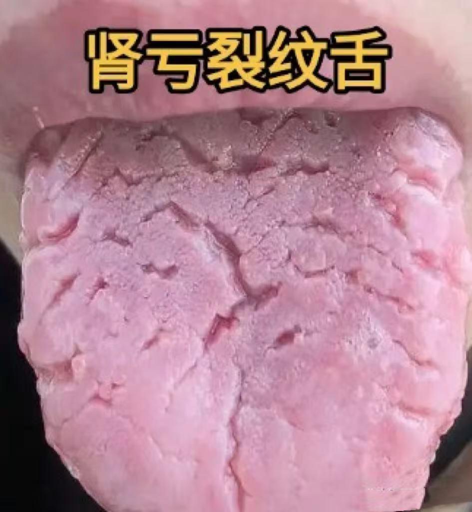 裂纹舌别乱补！记住这 3 个方，精亏裂纹用五子、血虚裂纹用四物、阳虚裂纹用真武！