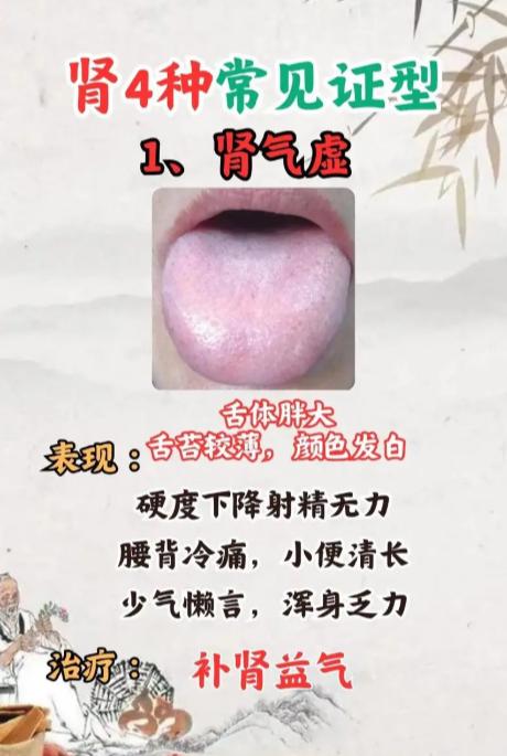 四种肾气不足的证型，一文带你分清