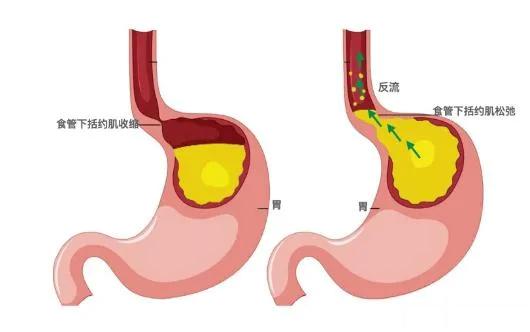 反流性食管炎有哪些症状表现反流性食管炎以下4个特征。第一个特征，晚上睡觉的时候容