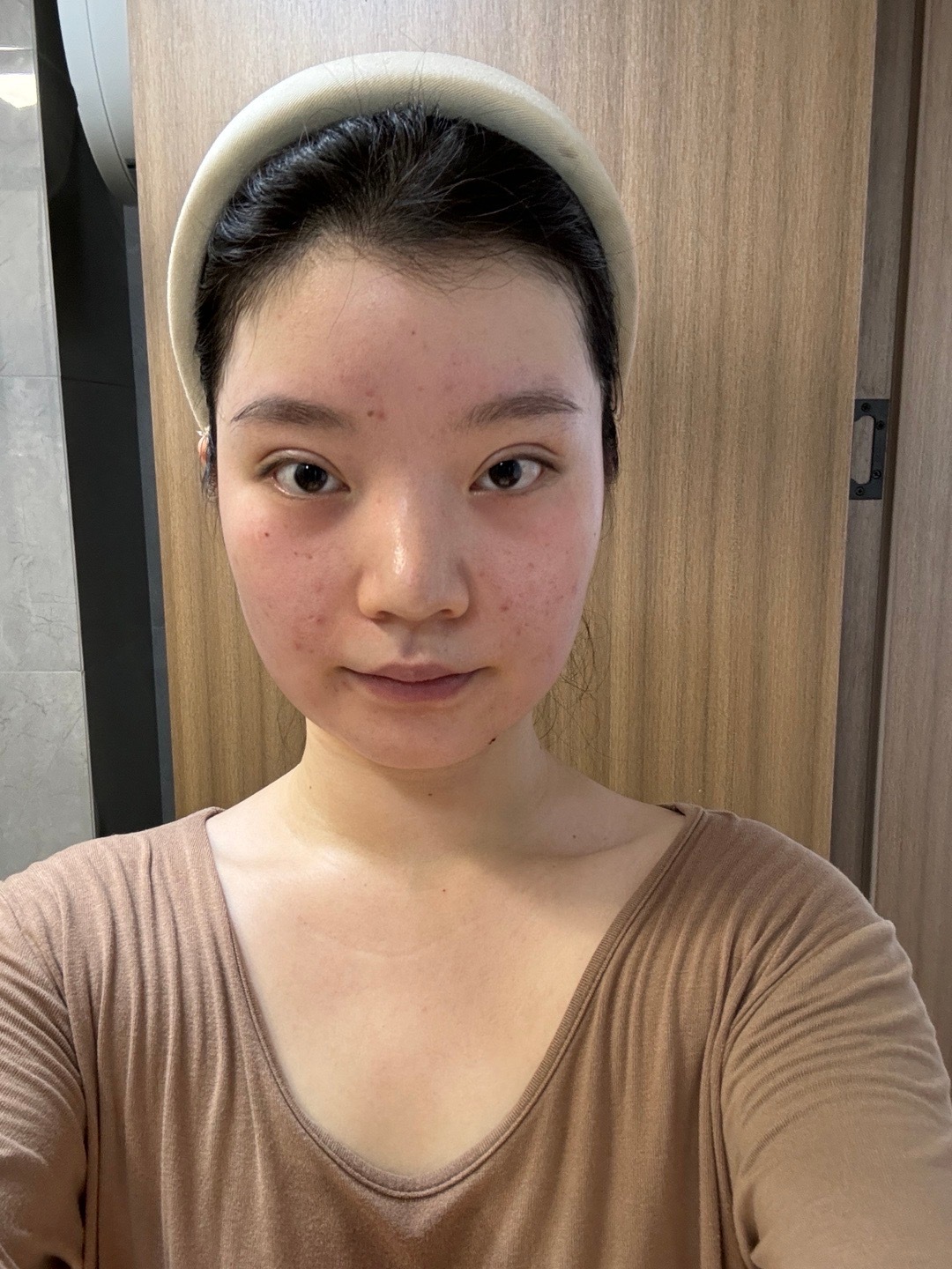 图一是面吸前 图二是面吸第6天 感觉脸更大了而且脸更不流畅了……真纯纯花钱找罪受