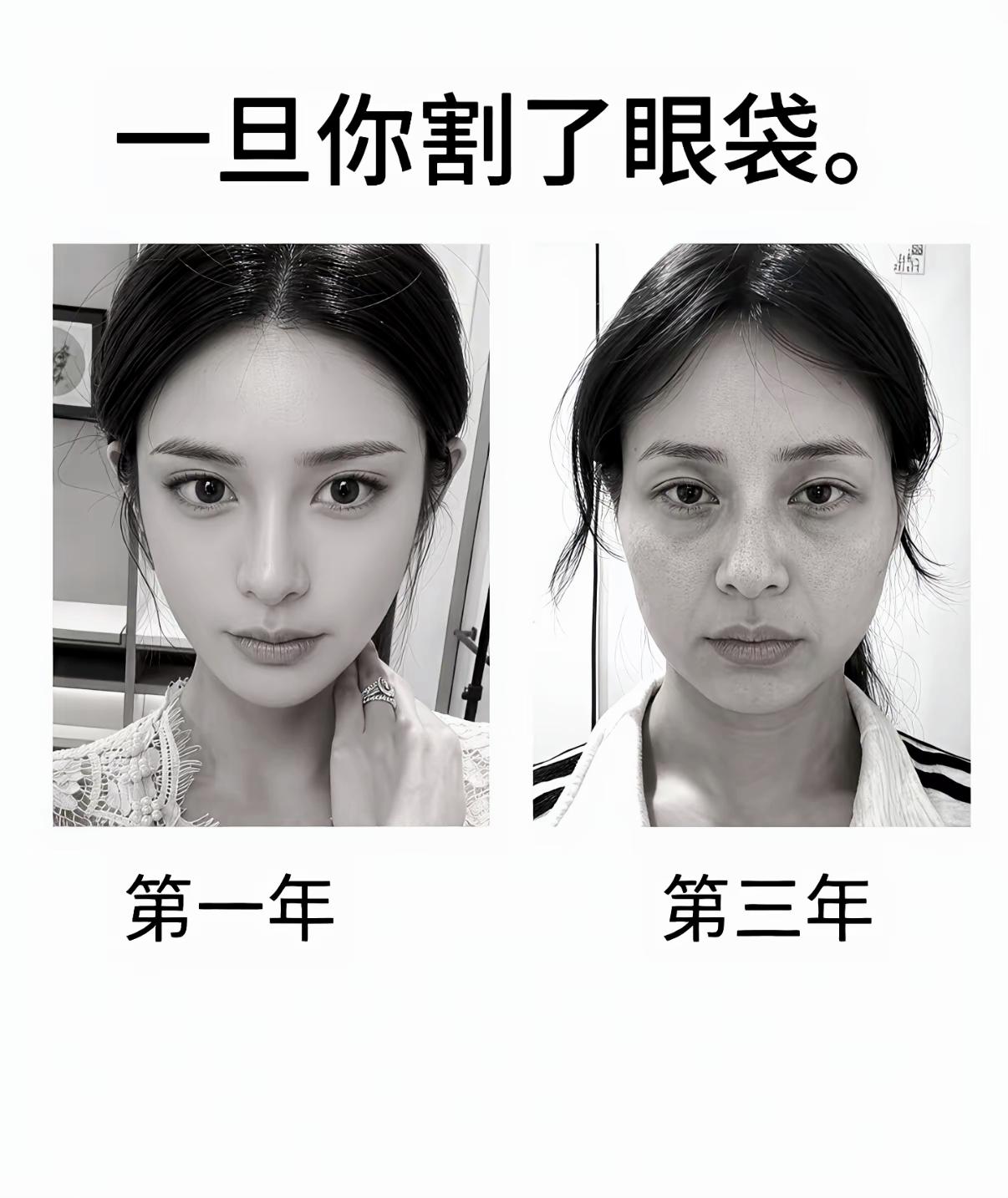 割眼袋短期颜值开挂，三年之后状态大跌，医美远期隐患很多人忽略了

医美理性科普 