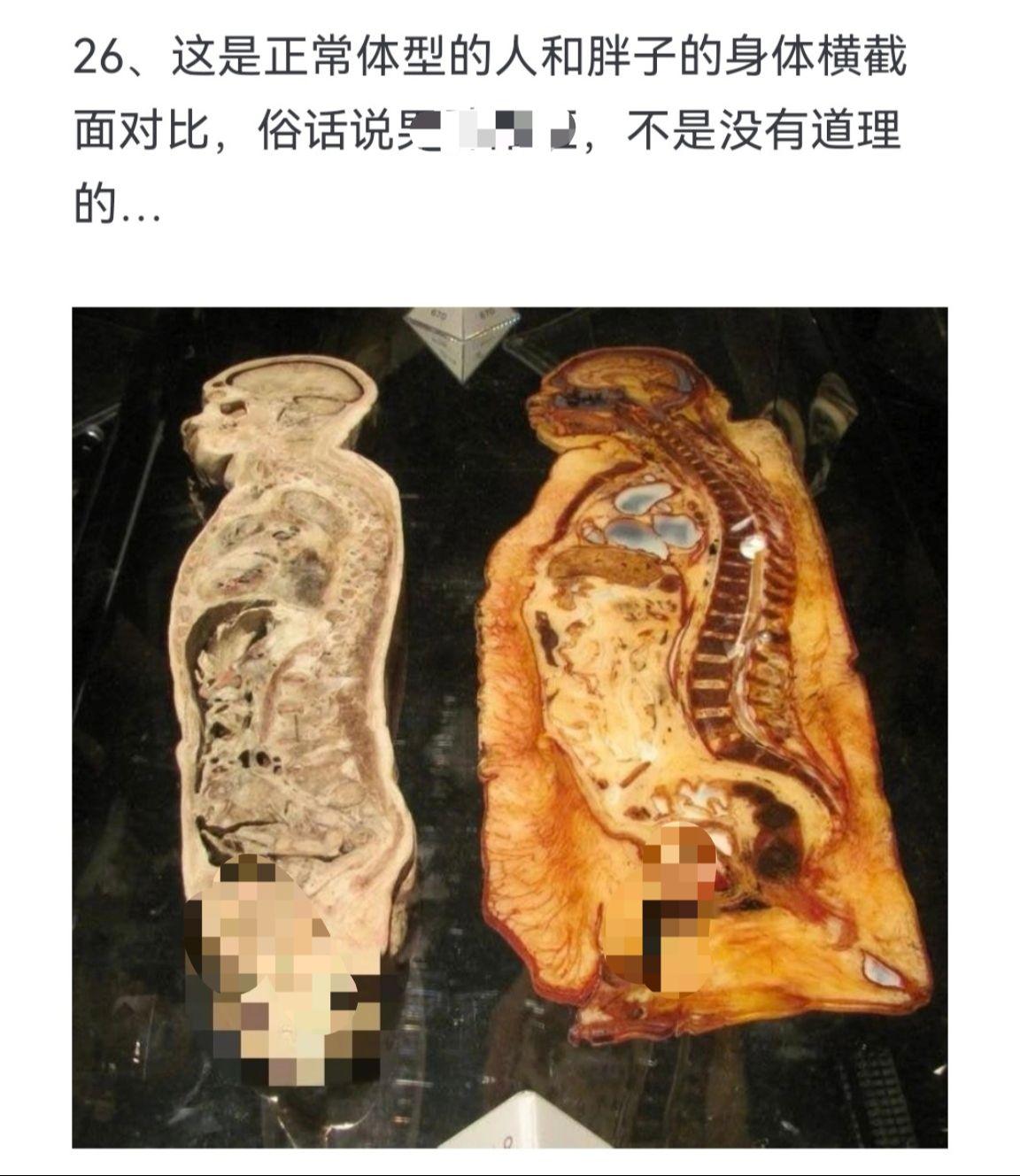 这是正常体型的人和胖子的身体横截面对比