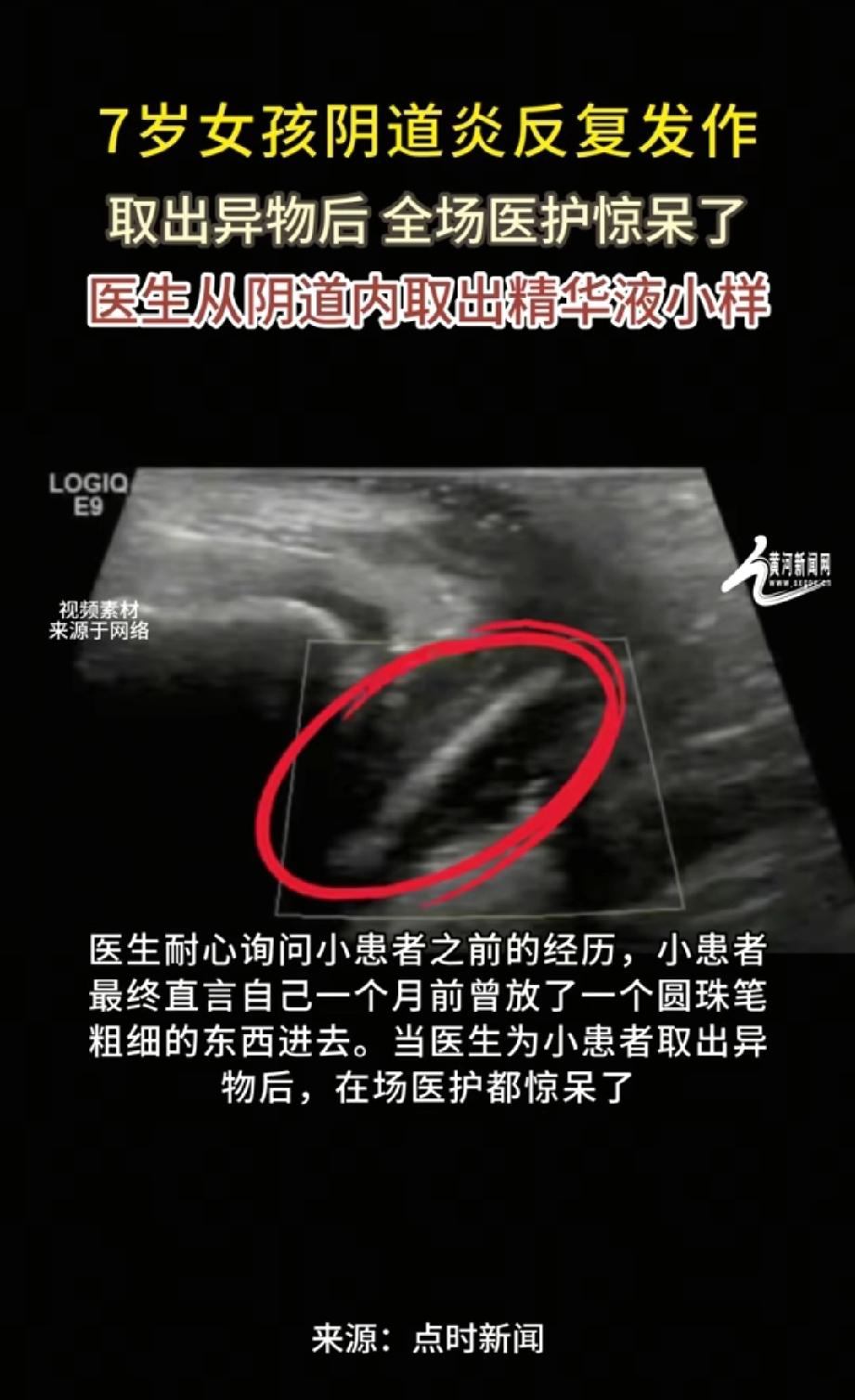 吓出一身冷汗！广东惠州，一名7岁女孩下体不舒服，以为抹抹药就好了，可孩子阴道炎反