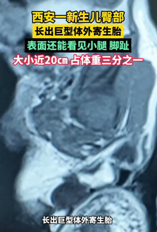 “活久见！”8月27日报道，陕西西安，一女子产检时，发现腹中胎儿臀部有个巨大包块