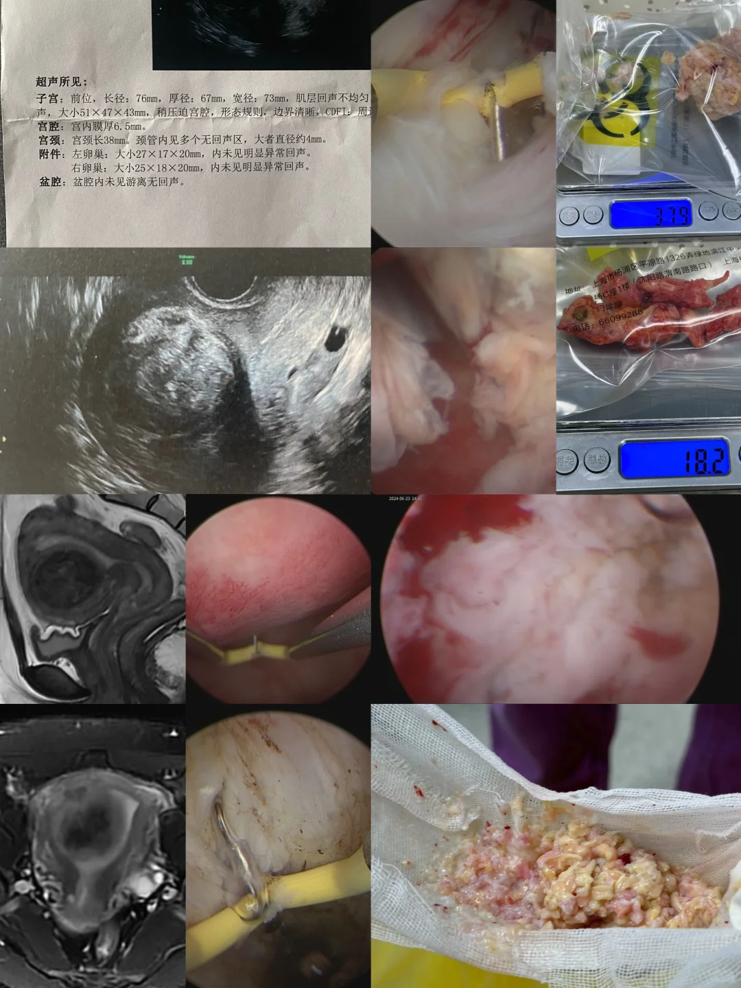 粘膜下肌瘤大部分在肌层内能否一次性切除