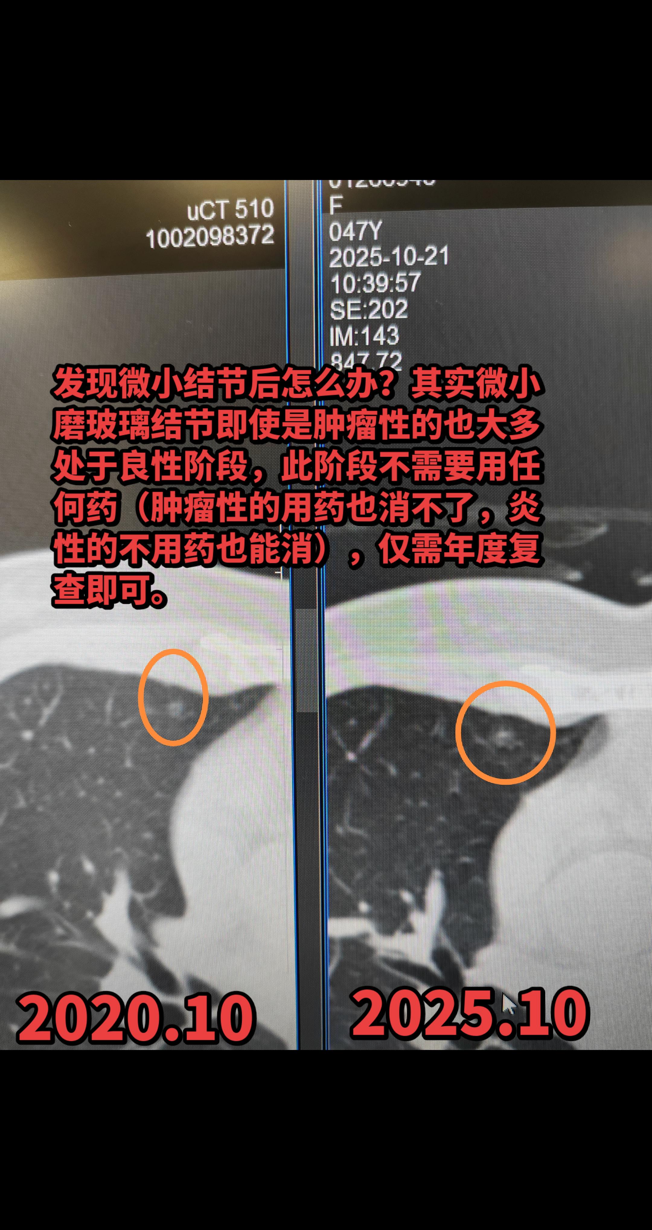 发现微小结节不用怕，年度复查观变化。发现微小结节后怎么办？其实微小磨玻...