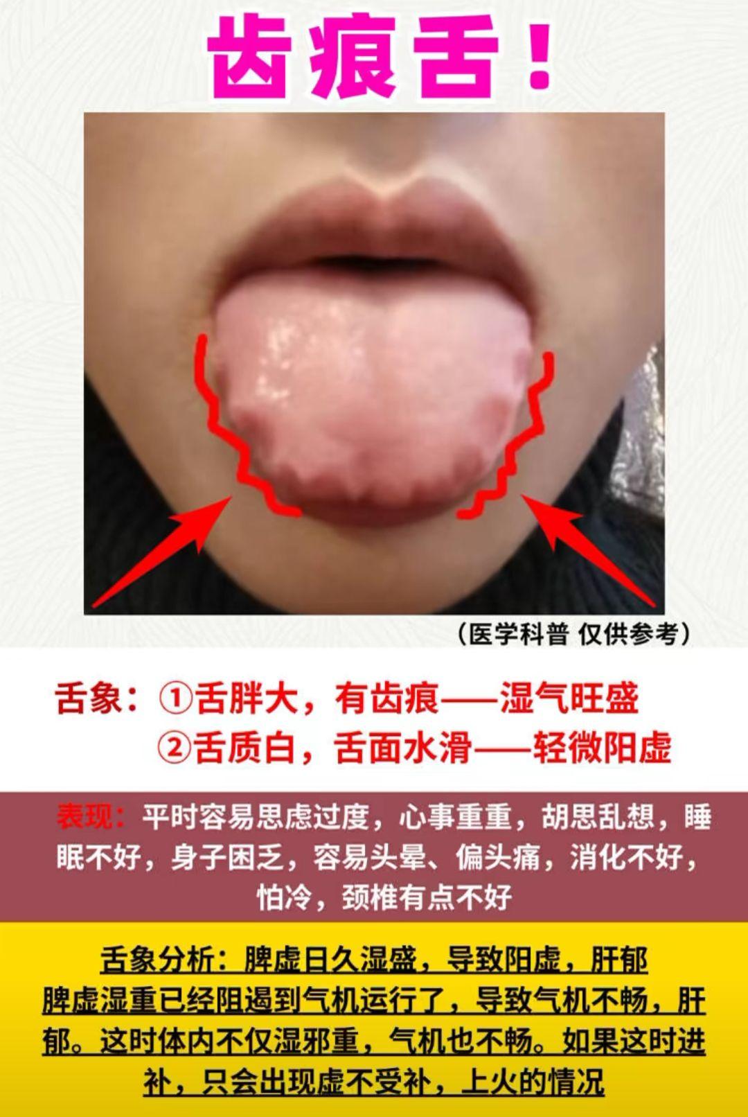 湿邪重、气机不畅？舌象告诉你真相！