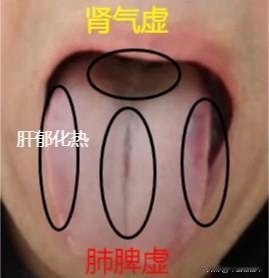 最怕这种舌象，裂纹舌，一看就知道不知道节制，把自己的身体都给掏空了
患者主诉：尿