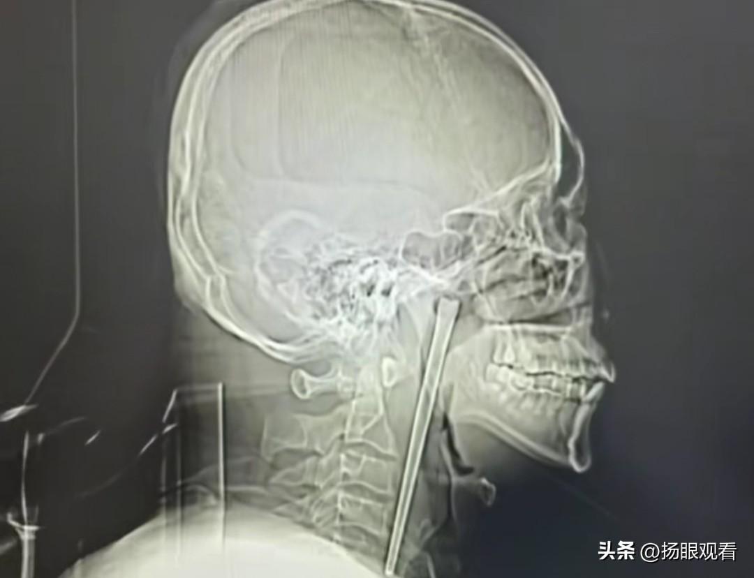 吓麻了😱辽宁男子误吞12cm筷子！体内藏了整整8年！
 
救命…看完浑身起鸡皮