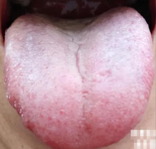 这类舌象，一看就是肾精亏虚，但是为啥吃了很多的五子衍宗都没用？
 
患者平时一吃