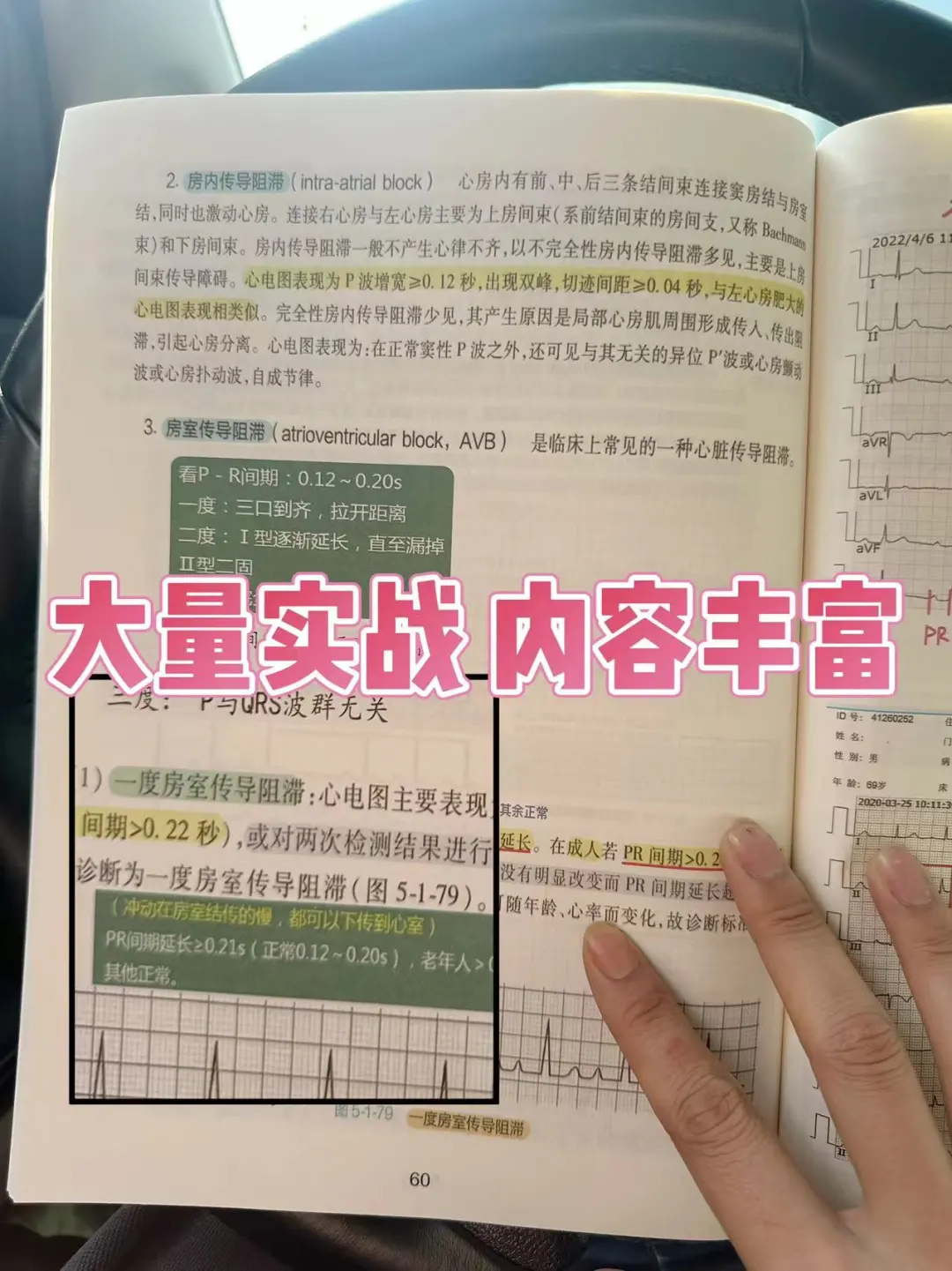 规培夜班医学生心电图