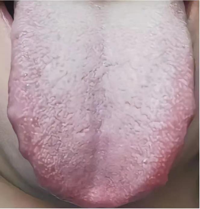 寒湿对于男性，简直是能力的一大考验！
 
舌头不仅胖大，还有齿痕，白腻苔，尤其是