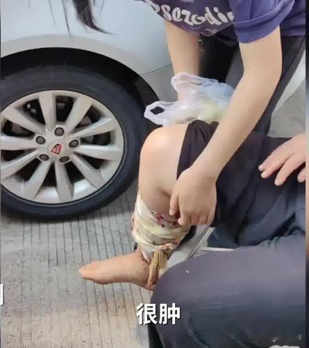 浙江，一位55岁的大姐上山捡板栗，知道山里可能有蛇，特意穿了雨靴，结果被五步蛇咬