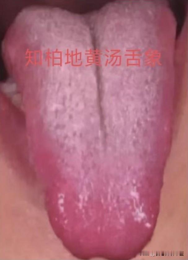 缺水是红舌，缺血是白舌，缺气是胖舌，一文帮你补满气、血、津（水）

1、缺水是红