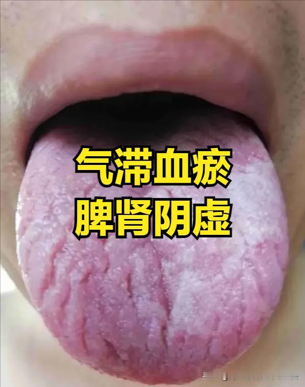 舌头能够很明显的反应我们身体的健康状态，糖友们学会看舌象，也能够让我们更好的了解