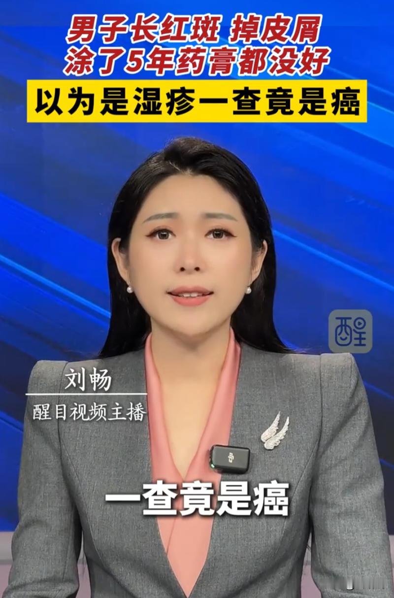 浙江宁波，一男子男子身上反复长红斑、掉皮屑，当成湿疹涂了五年药膏，可情况一直都没