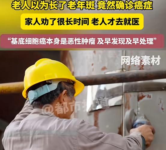 太吓人！河南郑州户外务工大爷误以为脸上斑块是普通老年斑，拖延未诊治，就医检查后确