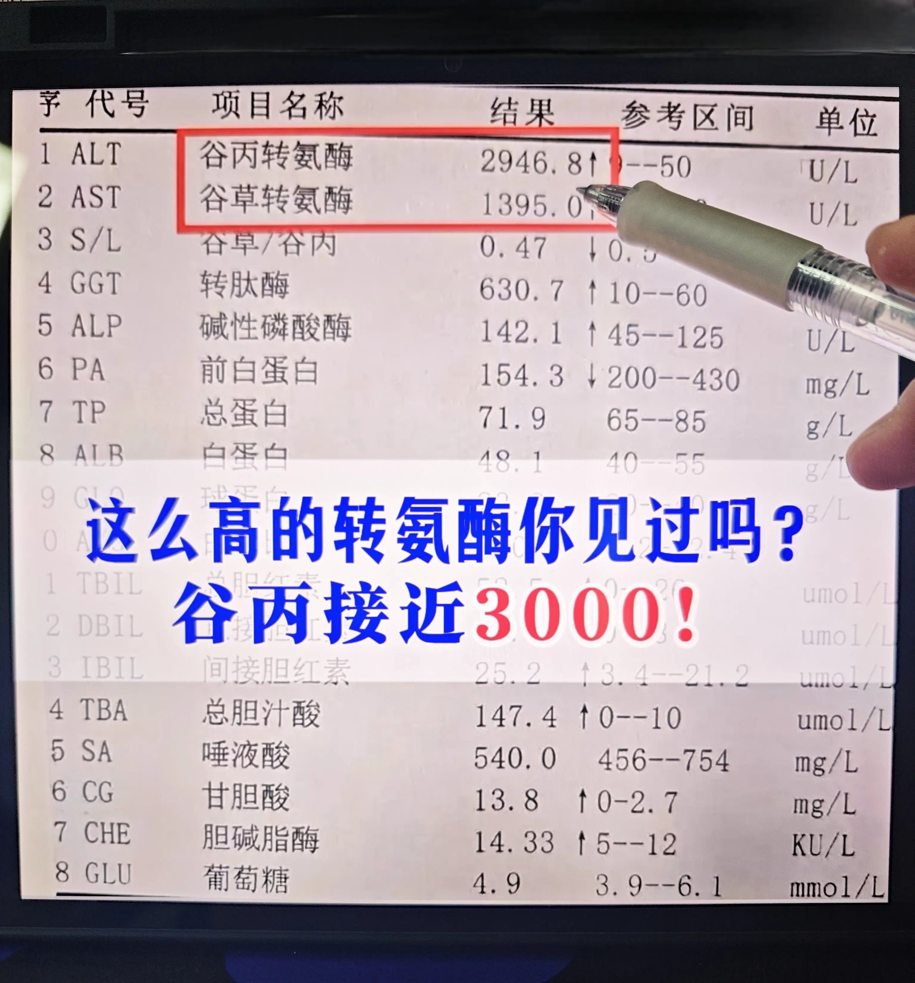 前几天专家门诊上一位临沂患者的转氨酶升高到近乎3000，病情非常的危急...