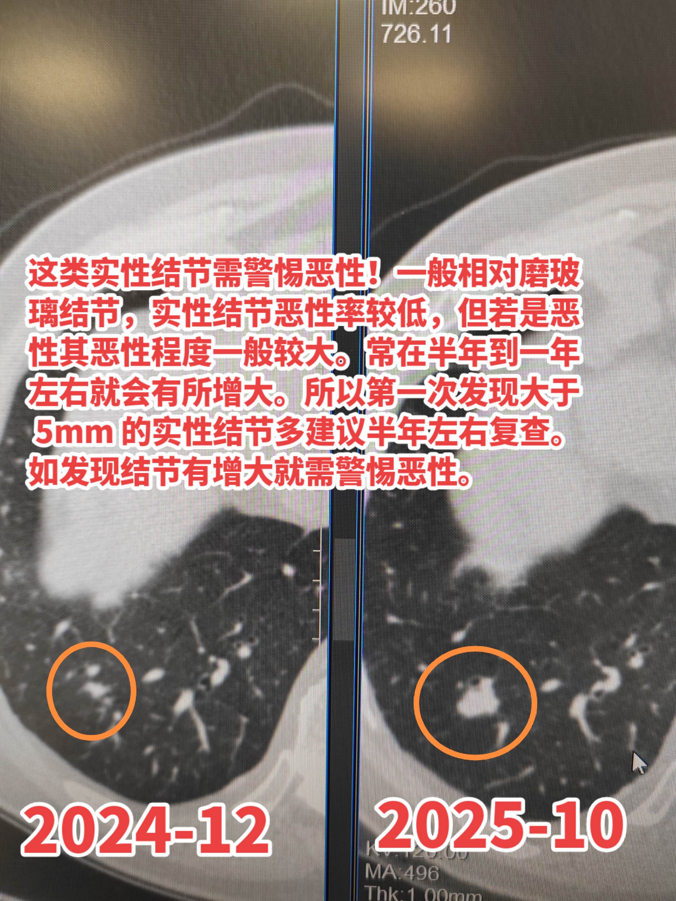 这类实性结节需警惕恶性！一般相对磨玻璃结节，实性结节恶性率较低，但若是...