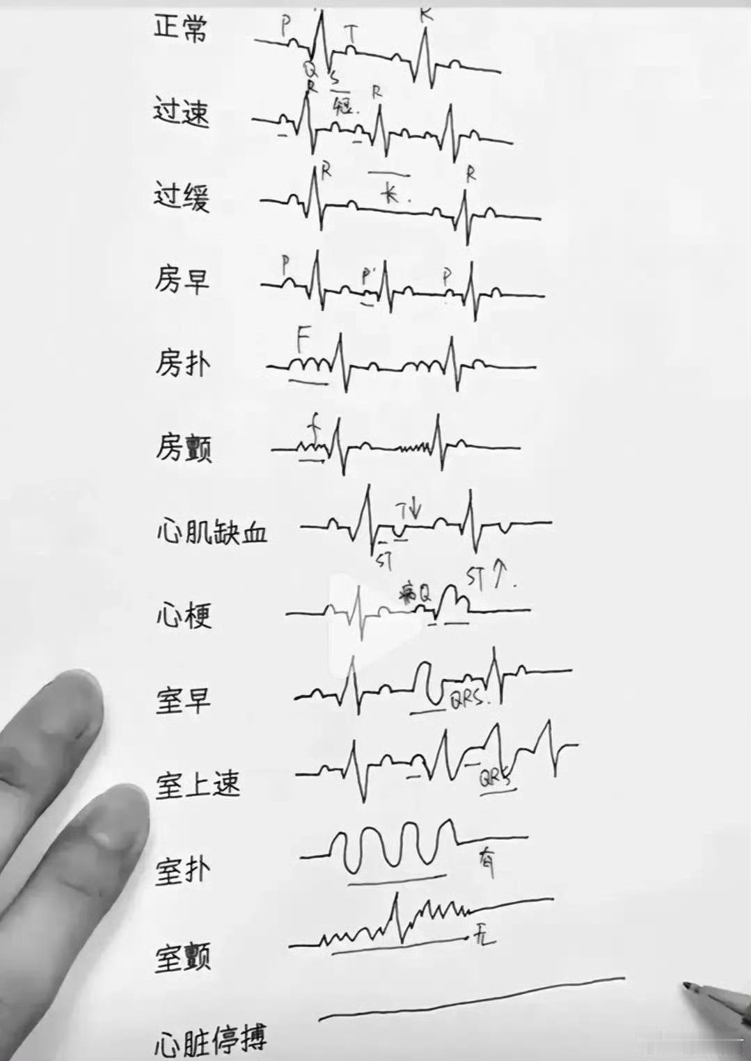 一分钟简单学会看心电图报告！ ​ ​​​